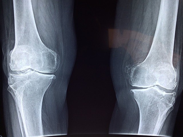 Rheuma + Arthrose = Polyarthritis